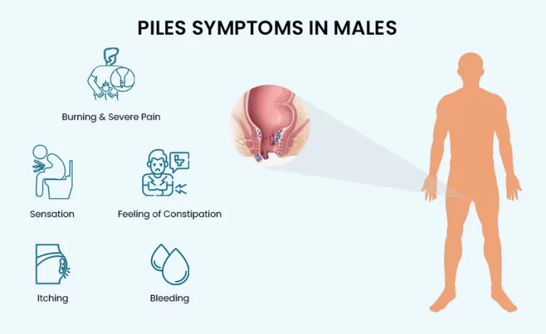 How to treat piles in males: their symptoms, causes, and treatments