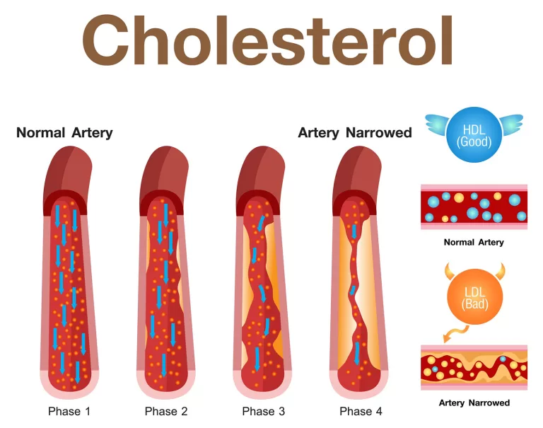 How Do Cholesterol Levels Affect Your Health?